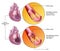 Reversible and progressive angina