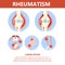 Rheumatism infographic. Bone disease on foot, hand