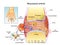 Rheumatoid Arthritis