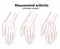 Rheumatoid arthritis bone hand. Palm and fingers. Vector image on white background. Flat design