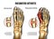 Rheumatoid arthritis Bones the of foot