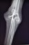 Rheumatoid arthritis finger xray pathology