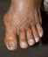 Rheumatoid arthritis in foot. Claw or hammer toes. Dislocation of joints