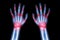 Rheumatoid arthritis , Gout arthritis ( Film x-ray both hands of child with multiple joint arthritis ) ( Medical , Science and He