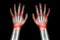 Rheumatoid arthritis , Gout arthritis ( Film x-ray both hands of child with multiple joint arthritis ) ( Medical , Science and He