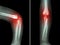 Rheumatoid arthritis , Gouty arthritis ( film x-ray child\'s elbow with arthritis at elbow ) ( Side and front view , Lateral and A