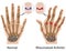 Rheumatoid arthritis of hand