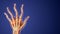 Rheumatoid arthritis of hand medical background