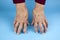 Rheumatoid Arthritis hands