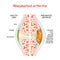 Rheumatoid arthritis. Healthy and damage joint