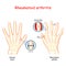 Rheumatoid Arthritis. Healthy hand, and hand with rheumatoid arthritis