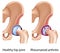 Rheumatoid arthritis of hip joint