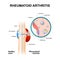 rheumatoid arthritis. normal joint and one with rheumatoid arthritis.