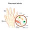 Rheumatoid Arthritis RA is an auto immune disease and inflammatory type of arthritis