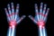 Rheumatoid arthritis ( X-ray both child hands and multiple joint arthritis )