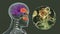 Rhinocerebral mucormycosis, a brain lesion and sinusitis caused by fungi Mucor