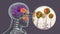 Rhinocerebral mucormycosis, a brain lesion and sinusitis caused by fungi Mucor