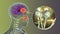 Rhinocerebral mucormycosis, a brain lesion and sinusitis caused by fungi Mucor