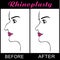 Rhinoplasty