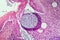 Rhinosporidium parasite diseased tissue