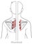 Rhomboid myofascial trigger points can cause local pain around the shoulder blades.