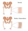 Rickets and Osteomalacia