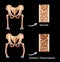 Rickets-osteomalacia