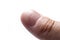 Ridged fingernail of a thumb finger of a man with vertical ridges on white background