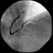 Right coronary artery