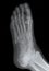 Right Foot Bottom Xray