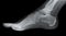 Right Foot Side X-ray