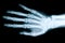 Right hand X-ray