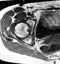 Right hip osteoarthritis pathology mri exam