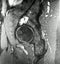 Right hip osteoarthritis pathology mri exam