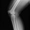 Right knee joint x-ray of mature female with osteoarthritis