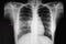 right middle lobe pneumonia