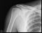 Right shoulder x-ray. Radiograph. Anteroposterior view.