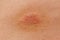 Ringworm on the skin of a person