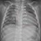 Roentgenogram of the chest in a child after cardiac surgery