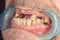 Rotten teeth, caries and plaque close-up in an asocially ill patient. The concept of poor hygiene and health problems