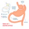 Roux-en-y gastric bypass bariatric surgery weight loss infographics