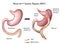 Roux-en-Y Gastric Bypass surgery