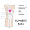 Runners knee