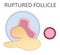 Ruptured follicle. Stage of developing follicle. Ovulation