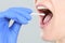 Saliva or Smear of oral mucosa with cotton swabs