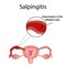 Salpingitis. Inflammation of the fallopian tube. Infographics. Vector illustration on background