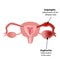 Salpingitis. Inflammation of the fallopian tube. Oophoritis. Inflammation of the ovary. pelvic organs. Infographics