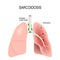 Sarcoidosis. Human`s lungs with granulomas