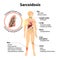 Sarcoidosis signs and symptoms
