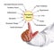 Sarcopenia Obesity